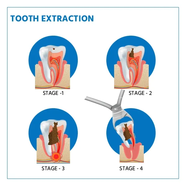 Tooth-Extraction-price